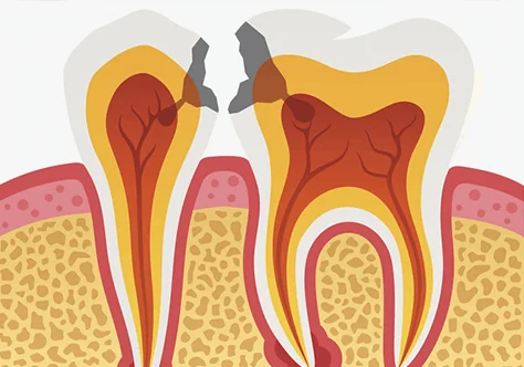 虫歯・歯周病のチェックイメージ
